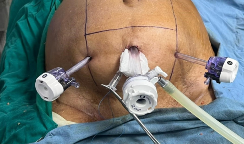 hernia overview